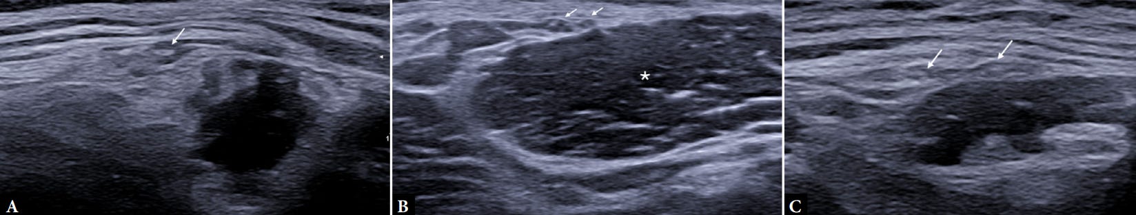 Meralgia parestesica tempo formacion ecografia 2.jpg